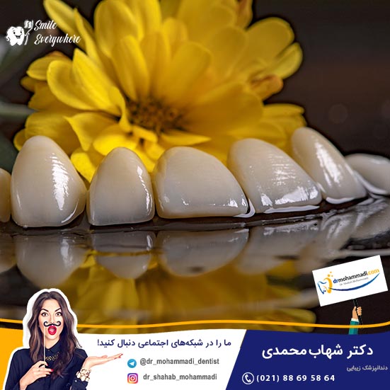 مزایا و معایب لمینت دندان سرامیکی - کلینیک دندانپزشکی دکتر شهاب محمدی